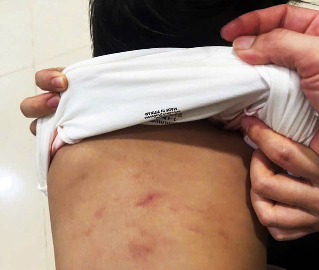 Cà Mau: Đề nghị công an điều tra trẻ 2 tuổi nghi bị bạo hành - Ảnh 1.