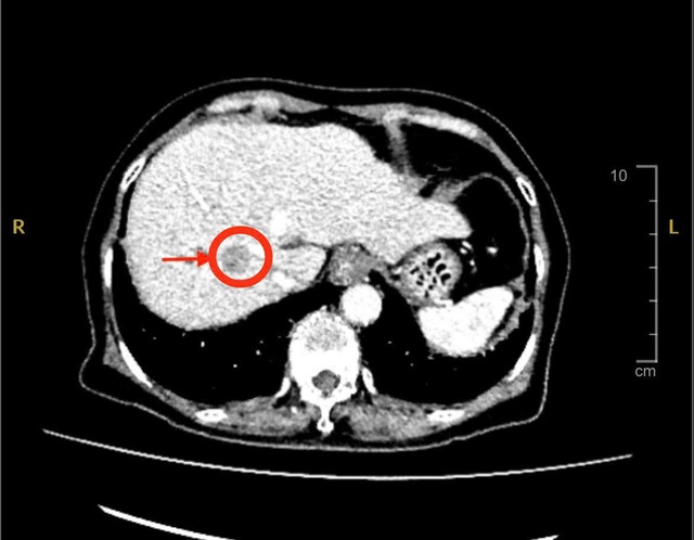 Đau bụng nhẹ, đi khám phát hiện ung thư gan - Ảnh 1.