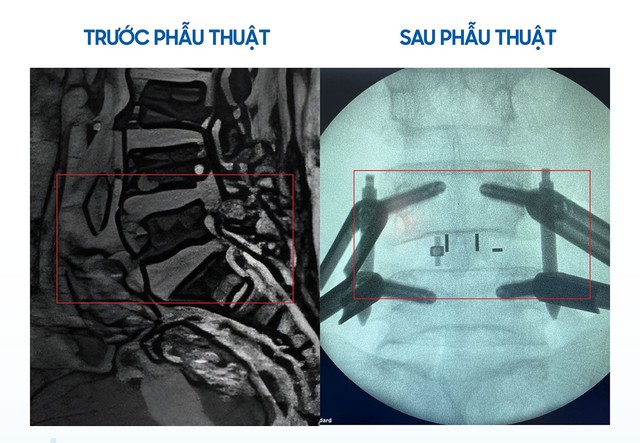 Mổ Cột Sống Cứu Người Cao Tuổi Nhiều Bệnh Nền Khỏi Nguy Cơ Liệt Chân Vĩnh Viễn Mổ Cột Sống Cứu Người Cao Tuổi Nhiều Bệnh Nền Khỏi Nguy Cơ Liệt Chân Vĩnh Viễn - Ảnh 3.