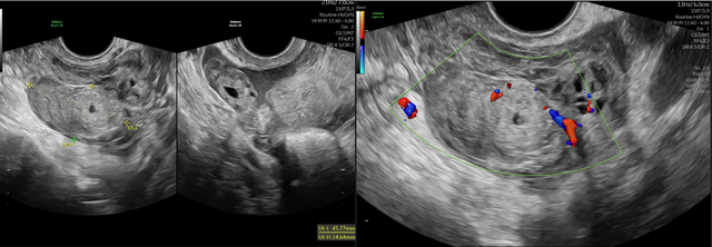 Người phụ nữ 31 tuổi su&yacute;t mất mạng do thai ngo&agrave;i tử cung vỡ - Ảnh 1.