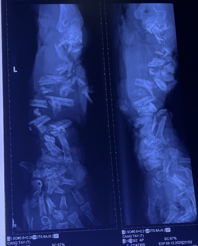 Ca tai nạn lao động thương tâm: Cánh tay bị máy nghiền vỏ dừa cán nát- Ảnh 1. Ca tai nạn lao động thương tâm: Cánh tay bị máy nghiền vỏ dừa cán nát- Ảnh 1.