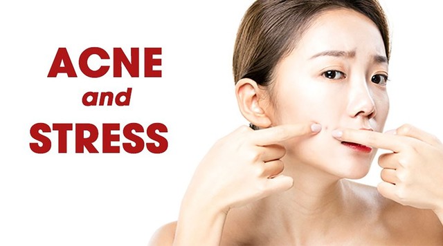 Ghim ngay cách cải thiện mụn tại nhà đơn giản mà hiệu quả, ngừa tái phát- Ảnh 2. Ghim ngay cách cải thiện mụn tại nhà đơn giản mà hiệu quả, ngừa tái phát- Ảnh 2.