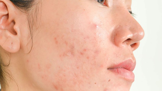 Ghim ngay cách cải thiện mụn tại nhà đơn giản mà hiệu quả, ngừa tái phát- Ảnh 3. Ghim ngay cách cải thiện mụn tại nhà đơn giản mà hiệu quả, ngừa tái phát- Ảnh 3.