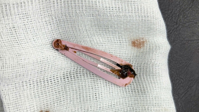 Ngủ trưa b&eacute; g&aacute;i 6 tuổi nuốt kẹp t&oacute;c d&agrave;i 7 cm v&agrave;o ổ bụng - Ảnh 1.