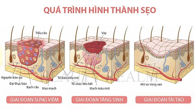 Những điều bạn cần biết trước khi chăm sóc sẹo lồi/phì đại - Ảnh 2.