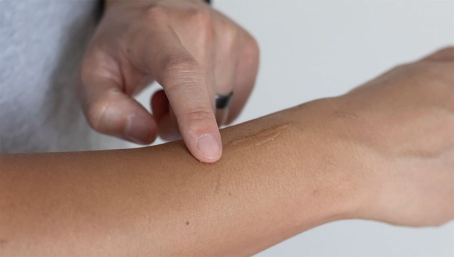 Những điều bạn cần biết trước khi chăm sóc sẹo lồi/phì đại - Ảnh 3.