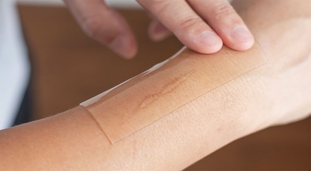 Những điều bạn cần biết trước khi chăm sóc sẹo lồi/phì đại - Ảnh 4.