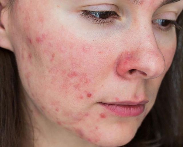 Vì đâu tổn thương da do mụn kéo dài mãi không hết? - Ảnh 1.