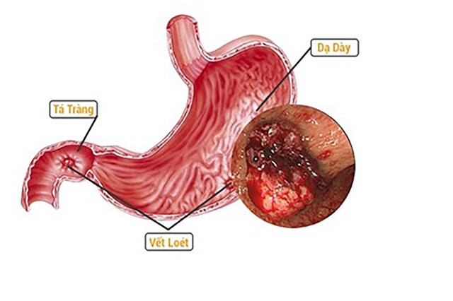 Cứu sống nam bệnh nh&acirc;n 68 tuổi bị xuất huyết ti&ecirc;u h&oacute;a nặng - Ảnh 1.