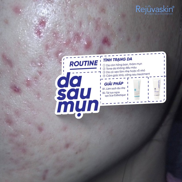 Vì đâu tổn thương da do mụn kéo dài mãi không hết? - Ảnh 2.