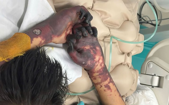 Nỗi đau người mẹ khi con trai cầu thủ cắt bỏ ch&acirc;n v&igrave; bệnh n&atilde;o m&ocirc; cầu - Ảnh 4.