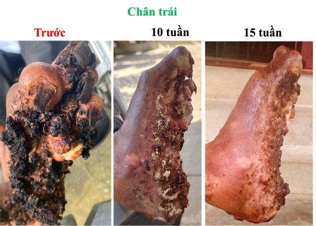 Giải m&atilde; b&iacute; ẩn bệnh &ldquo;người c&acirc;y&rdquo; hiếm gặp tại Việt Nam - Ảnh 2.