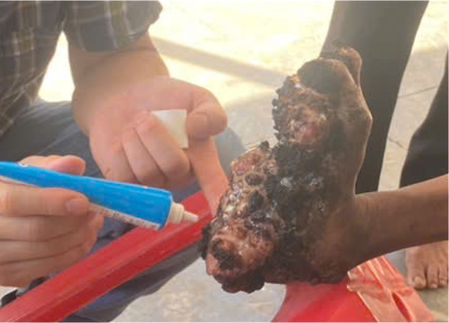 Giải m&atilde; b&iacute; ẩn bệnh &ldquo;người c&acirc;y&rdquo; hiếm gặp tại Việt Nam - Ảnh 3.