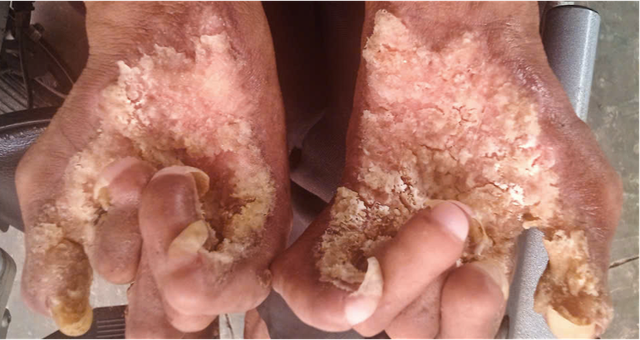 Giải m&atilde; b&iacute; ẩn bệnh &ldquo;người c&acirc;y&rdquo; hiếm gặp tại Việt Nam - Ảnh 1.