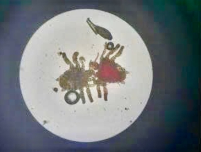 Người đ&agrave;n &ocirc;ng 56 tuổi bị ngứa dữ dội do rận k&yacute; sinh- Ảnh 1.