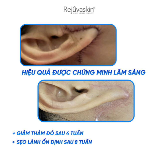 Bắt trend chăm sẹo không sợ lồi/phì đại đang có mặt trong viện thẩm mỹ nổi danh- Ảnh 6. Bắt trend chăm sẹo không sợ lồi/phì đại đang có mặt trong viện thẩm mỹ nổi danh- Ảnh 6.