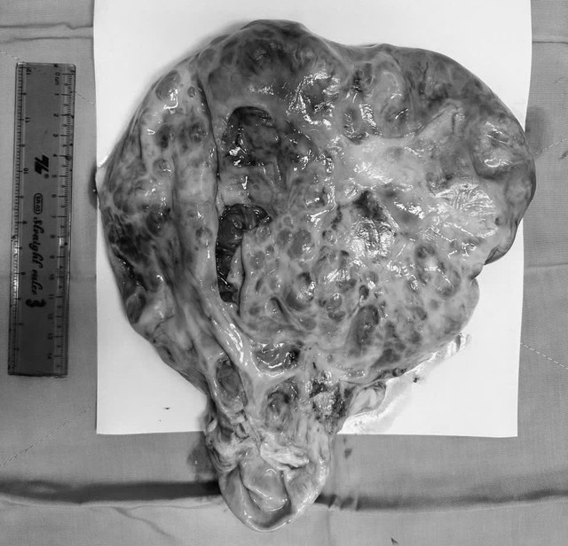 Phẫu thuật nội soi cắt khối u nặng hơn 6 kg cho nữ bệnh nh&acirc;n 65 tuổi - Ảnh 2.