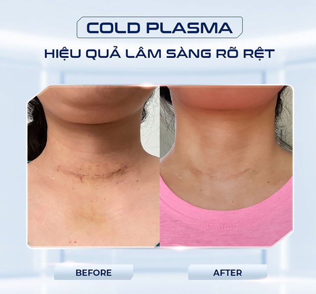 M&aacute;y Plasma Lạnh l&agrave; g&igrave;? C&ocirc;ng dụng của Plasma Lạnh trong thẩm mỹ?- Ảnh 4.