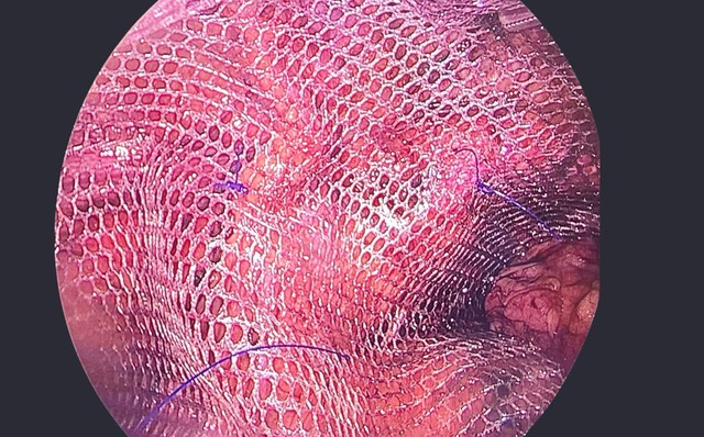 Người đàn ông 51 tuổi suýt gặp biến chứng nguy hiểm vì khối phồng vùng bẹn- Ảnh 2. Người đàn ông 51 tuổi suýt gặp biến chứng nguy hiểm vì khối phồng vùng bẹn- Ảnh 2.