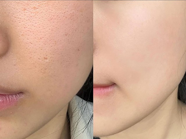 Cẩm nang chăm s&oacute;c da sẹo rỗ phục hồi phẳng mịn sau laser b&oacute;c t&aacute;ch- Ảnh 1.