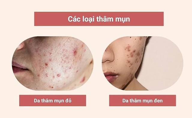 Mụn th&acirc;m đen cứng đầu, l&acirc;u năm cải thiện bật s&aacute;ng đều m&agrave;u sau 7 ng&agrave;y- Ảnh 2.