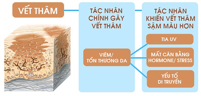 Mụn th&acirc;m đen cứng đầu, l&acirc;u năm cải thiện bật s&aacute;ng đều m&agrave;u sau 7 ng&agrave;y- Ảnh 3.