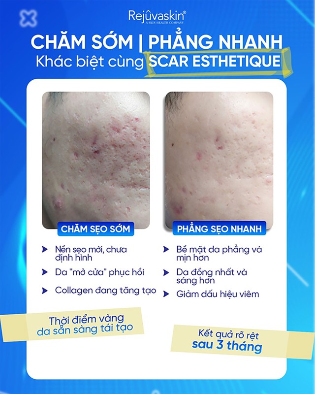 Cẩm nang chăm s&oacute;c da sẹo rỗ phục hồi phẳng mịn sau laser b&oacute;c t&aacute;ch- Ảnh 5.