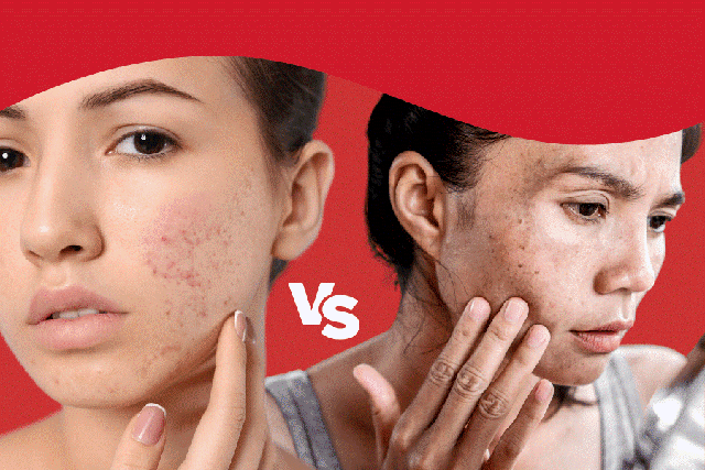 Hết th&acirc;m đỏ sau mụn nhanh: C&aacute;ch chọn sản phẩm chuẩn khoa học- Ảnh 1.