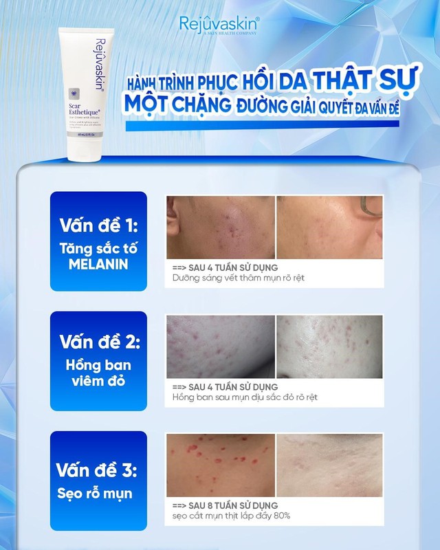 Hết th&acirc;m đỏ sau mụn nhanh: C&aacute;ch chọn sản phẩm chuẩn khoa học- Ảnh 3.