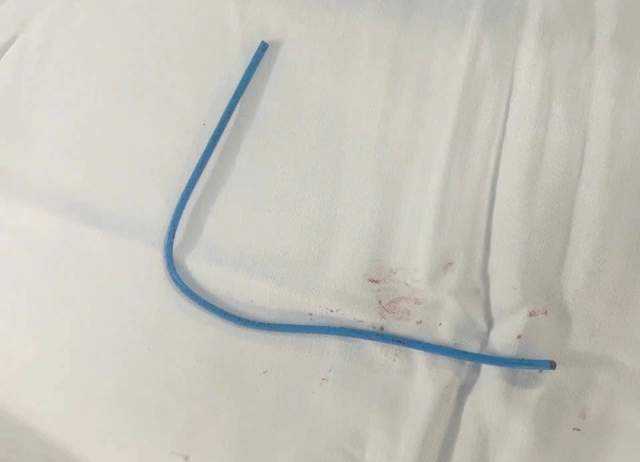 Bệnh viện Qu&acirc;n y 175 tiếp nhận ca bệnh dị vật kẹt trong tim hiếm gặp - Ảnh 1.