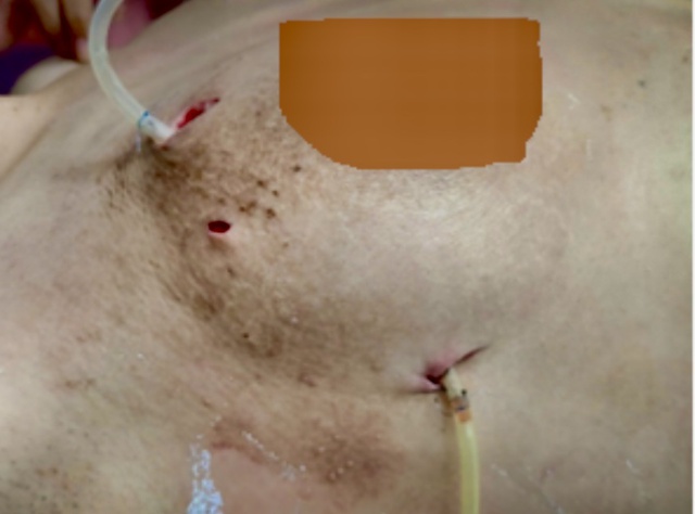 Ngực biến dạng do ti&ecirc;m filler l&agrave;m đẹp- Ảnh 1.