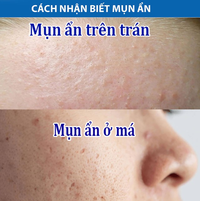 Bất ngờ chưa: Trioderma ngừa mụn ẩn hiệu quả đến mức chuy&ecirc;n gia cũng phải c&ocirc;ng nhận!- Ảnh 2.