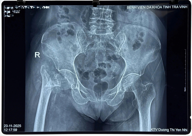 Lần đầu ti&ecirc;n thay khớp h&aacute;ng th&agrave;nh c&ocirc;ng cho cụ b&agrave; 100 tuổi - Ảnh 2.