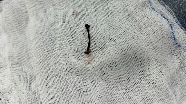 Tắm suối, b&eacute; trai 30 th&aacute;ng tuổi bị vắt chui v&agrave;o mũi- Ảnh 1.