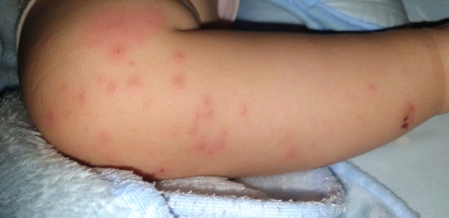 Chủng vi r&uacute;t g&acirc;y bệnh tay ch&acirc;n miệng nặng xuất hiện trở lại ở TP.HCM- Ảnh 2.