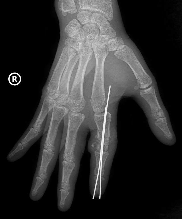 Cứu sống ngón tay thủy thủ bị đứt rời sau 25 giờ- Ảnh 1. Cứu sống ngón tay thủy thủ bị đứt rời sau 25 giờ- Ảnh 1.