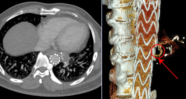 Siêu máy chụp CT phát hiện sớm đột quỵ, ung thư tạng- Ảnh 3.