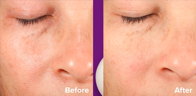 Ghim ngay top 4 serum trị đốm n&acirc;u cho n&agrave;ng năm mới khởi sắc 0% khuyết điểm- Ảnh 2.