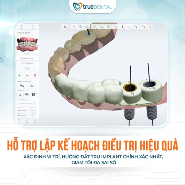 Cấy ghép Implant an toàn, không đau với máng định vị phẫu thuật AI tại True Dental- Ảnh 2.