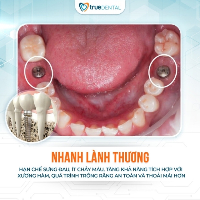 Cấy ghép Implant an toàn, không đau với máng định vị phẫu thuật AI tại True Dental- Ảnh 4.