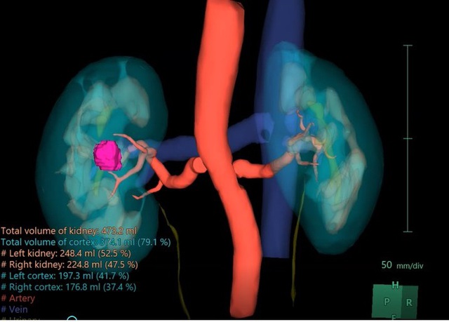 Khám sức khỏe bất ngờ phát hiện ung thư thận- Ảnh 1.