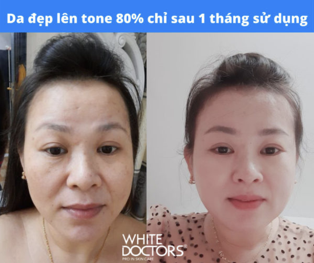 Review kem trị nám, tàn nhang thể nặng White Doctors Melasma Pro có tốt không?- Ảnh 3.