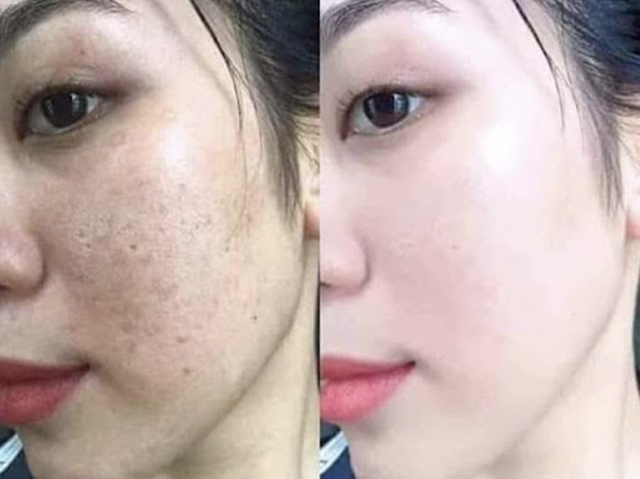 Review kem trị nám, tàn nhang thể nặng White Doctors Melasma Pro có tốt không?- Ảnh 7.