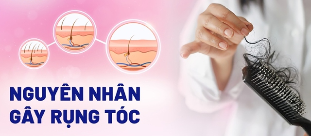 Tóc rụng ‘tả tơi’ sau mỗi lần gội: Nguyên nhân và giải pháp khắc phục toàn diện - Ảnh 3.