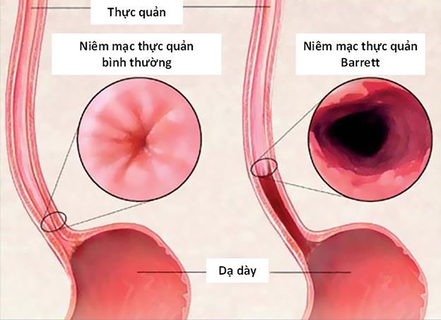 Điều trị trào ngược dạ dày bằng nội soi thắt tâm vị và đốt Argon Plasma- Ảnh 4.