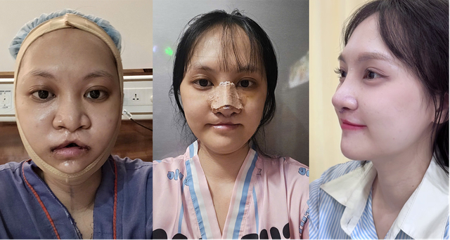 Hành trình 180 ngày lột xác của cô gái hàm ếch Minh Xuân- Ảnh 3.
