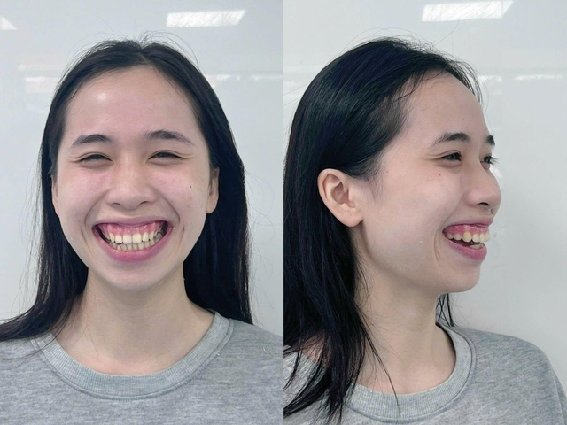 Cuộc sống của TikToker A Nha sau phẫu thuật h&agrave;m tại Bệnh viện Răng H&agrave;m Mặt Paris- Ảnh 1.