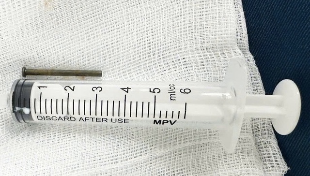 Bệnh viện Quảng Ngãi gắp cây đinh sắt dài 3cm trong tá tràng bé trai 6 tuổi - Ảnh 2.
