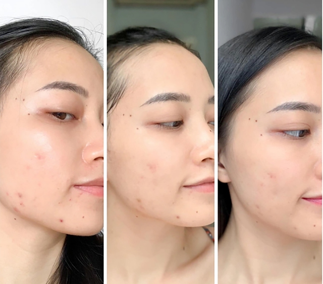 Chấm dứt nỗi lo da bị thâm mụn trong 4 tuần, da trắng sáng đều màu- Ảnh 1.