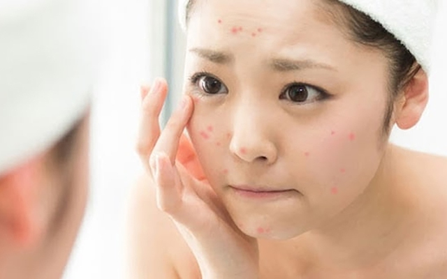 Chấm dứt nỗi lo da bị thâm mụn trong 4 tuần, da trắng sáng đều màu- Ảnh 2.